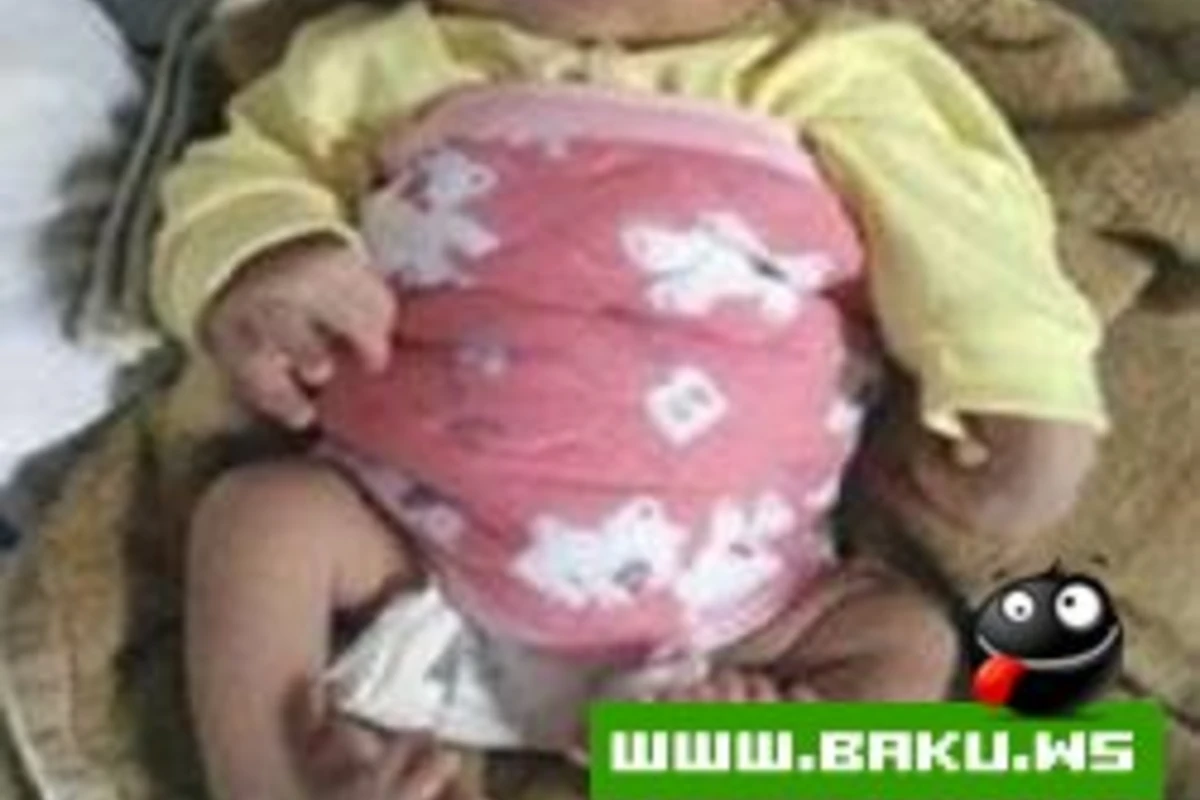 Şəmkirdə 23 barmaqlı uşaq dünyaya gəlib