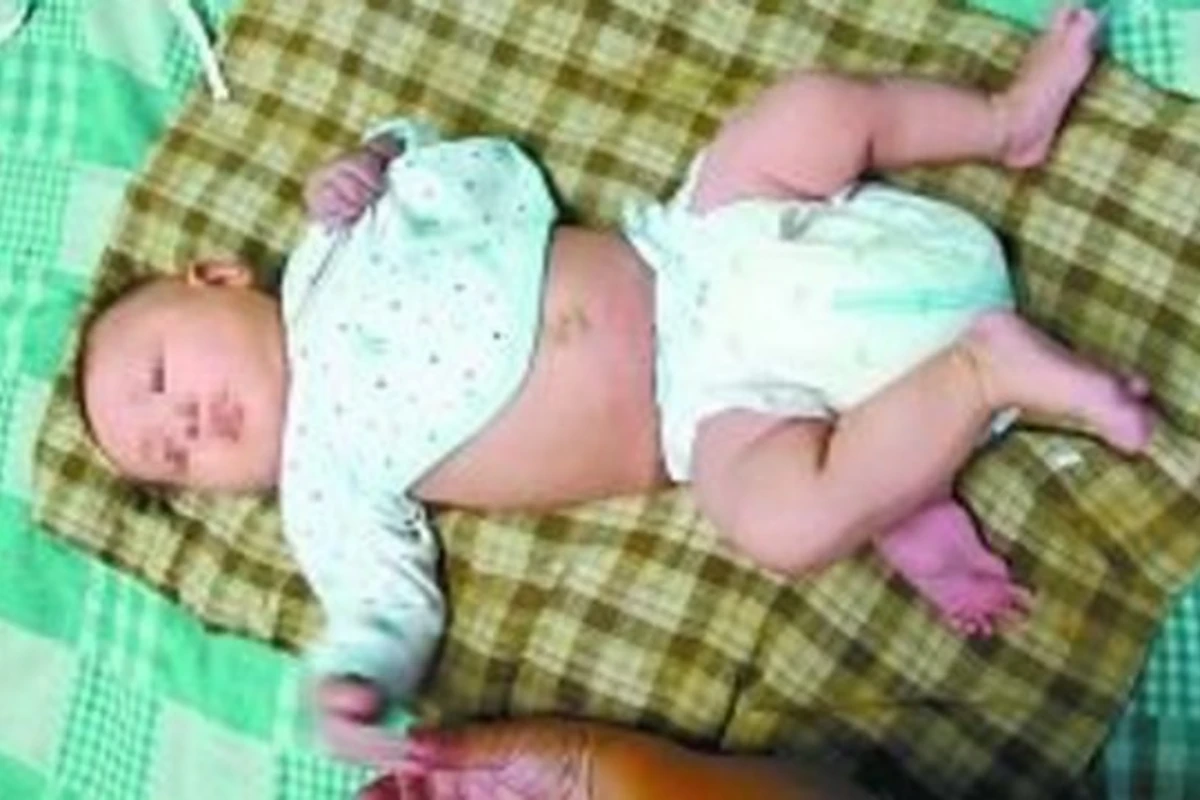 В Китае родился трехногий ребенок