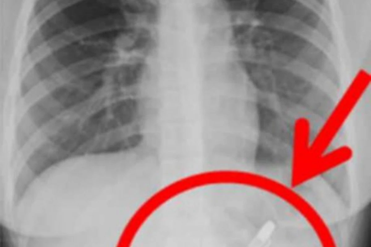 Врачи обнаружили в желудке 20-летней пациентки авторучку