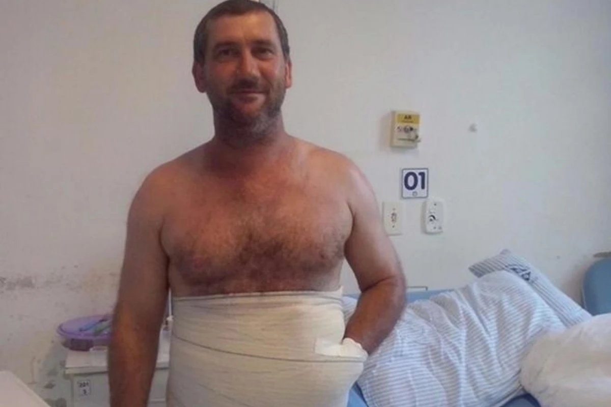 Врачи зашили мужчине руку в живот