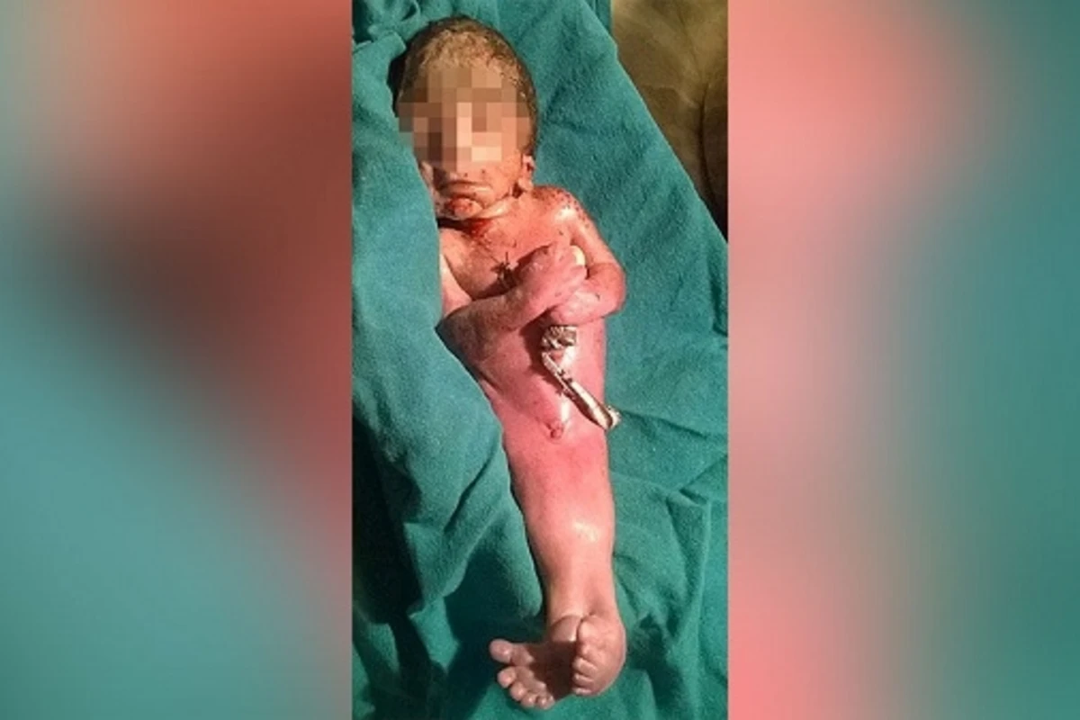 В Индии женщина родила русалкоподобного ребенка (фото)
