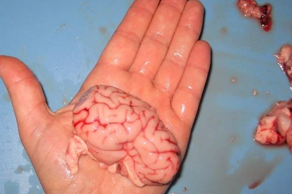 Həkimlər şokda: 16 yaşlı qızın yumurtalığından görün nələr çıxdı (FOTO)