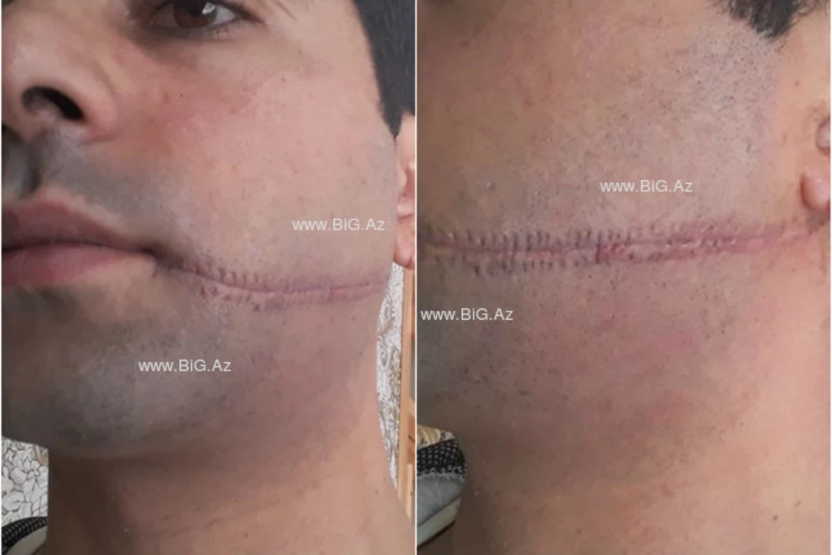 Azərbaycanda DƏHŞƏTLİ CİNAYƏT: 26 yaşlı gəncin ağzını kəsdilər - FOTO