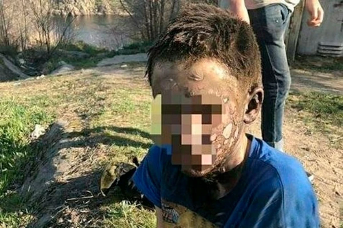 Подросток остался жив после удара током в 10 тысяч вольт - ФОТО