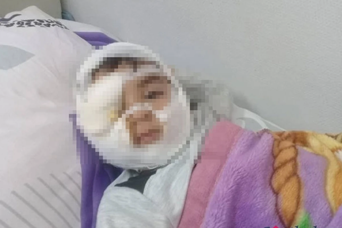 В Баку собака раскромсала лицо 4-летнему ребенку - ФОТО