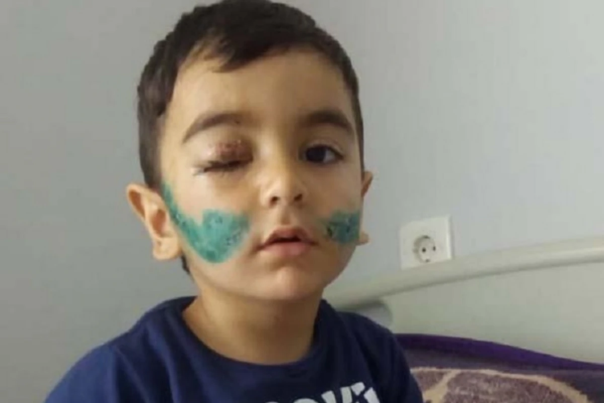 Üzünü it parçalayan uşağın SON DURUMU - FOTO