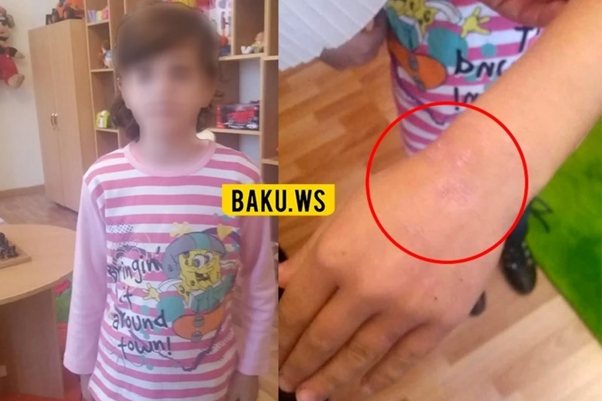 В Азербайджане мать тушила окурки сигарет на руке 10-летней дочери - ФОТО В Азербайджане мать тушила окурки сигарет на руке 10-летней дочери - ФОТО