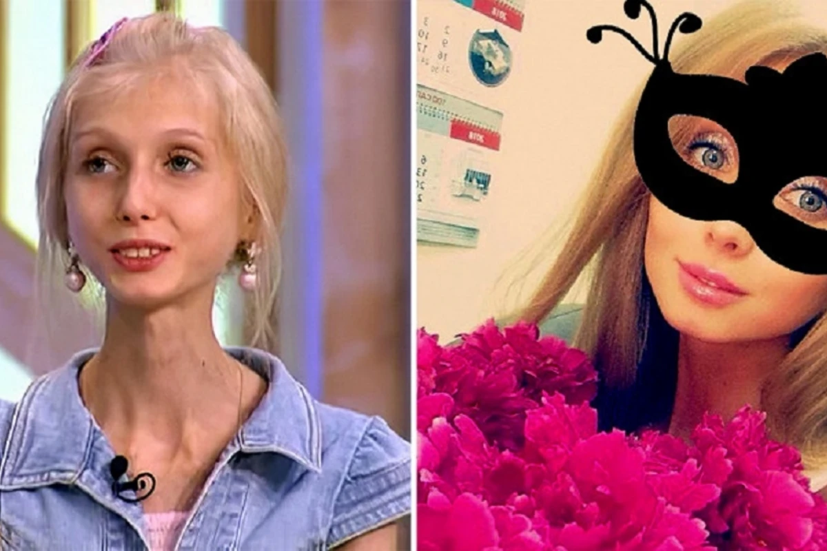 Невероятное преображение девушки, которая весила 23 килограмма - ФОТО Невероятное преображение девушки, которая весила 23 килограмма - ФОТО