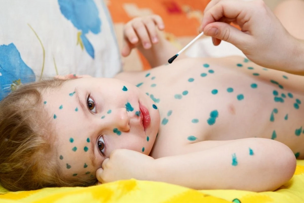 Ötən il Azərbaycanda suçiçəyinə və qızılcaya yoluxanların sayı açıqlandı