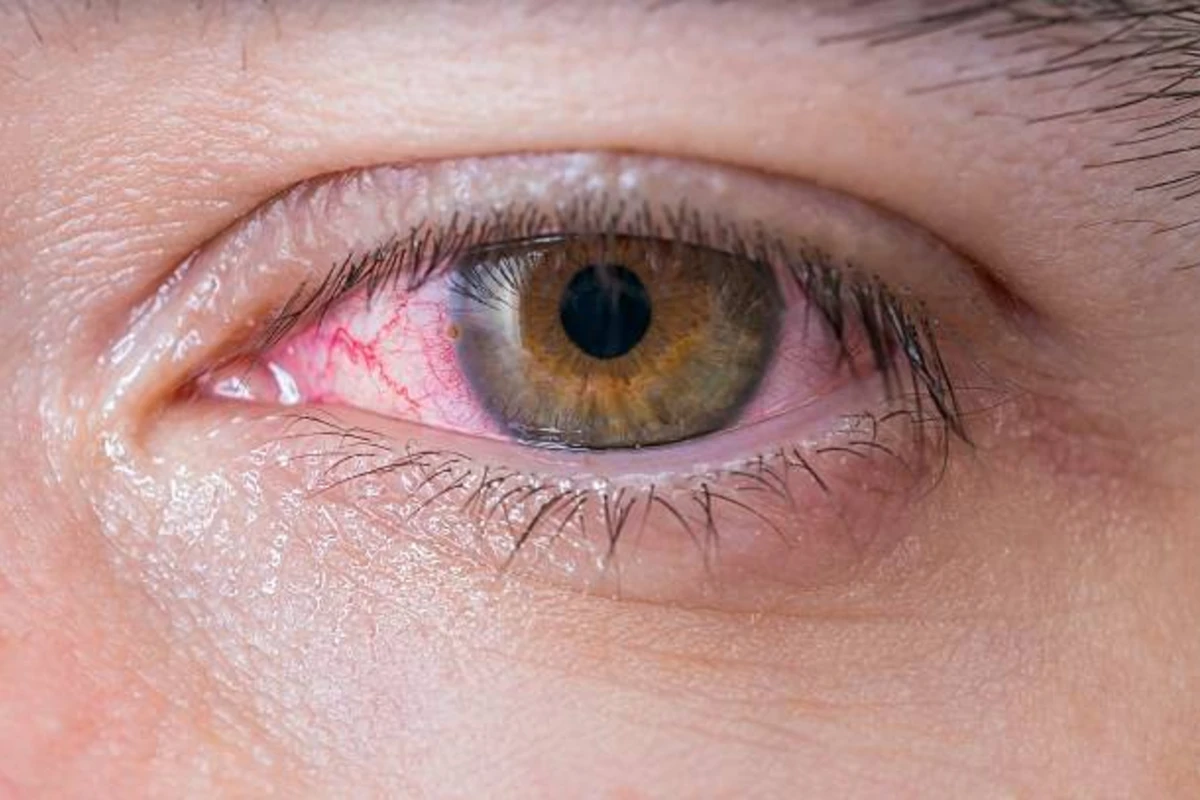 Koronavirus gözə necə təsir edir? Koronavirus gözə necə təsir edir?