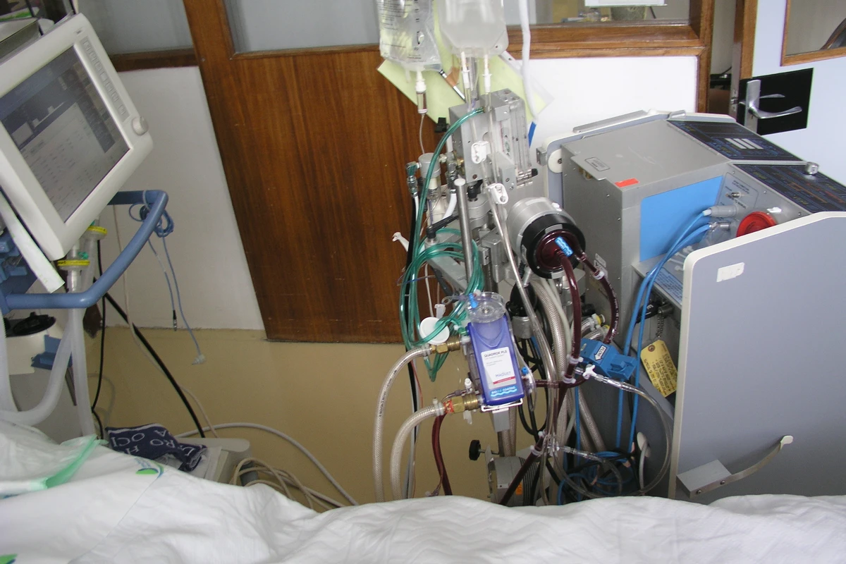 Koronavirusa yoluxmuş həkimin vəziyyəti ağırlaşdı, ECMO cihazına qoşuldu Koronavirusa yoluxmuş həkimin vəziyyəti ağırlaşdı, ECMO cihazına qoşuldu