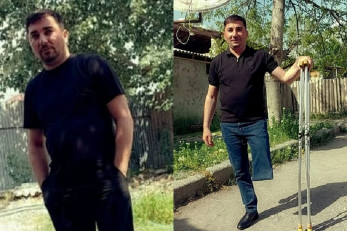 Vətən uğrunda ayağını qurban vermiş qazi: “Əlillik dərəcəsi alan kimi, protezlə təmin olundum” - MÜSAHİBƏ Vətən uğrunda ayağını qurban vermiş qazi: “Əlillik dərəcəsi alan kimi, protezlə təmin olundum” - MÜSAHİBƏ