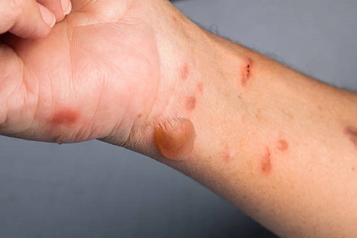 COVID-19 və meymunçiçəyi epidemiyası bitmədən yeni virus yayılır - Pomidor qripi