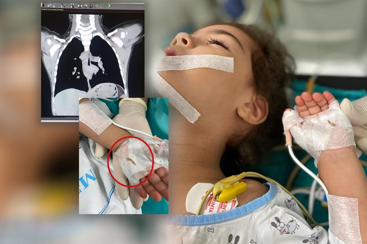 Bakıda 2 yaşlı uşaq bir il nəfəs borusunda sümük parçası ilə yaşayıb - FOTO