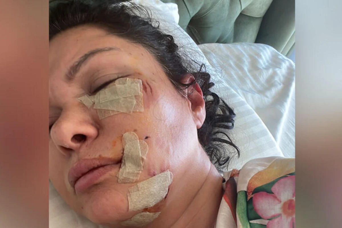 Rafet El Romanın eks arvadına it hücum etdi: Üzünə tikiş atıldı - FOTO