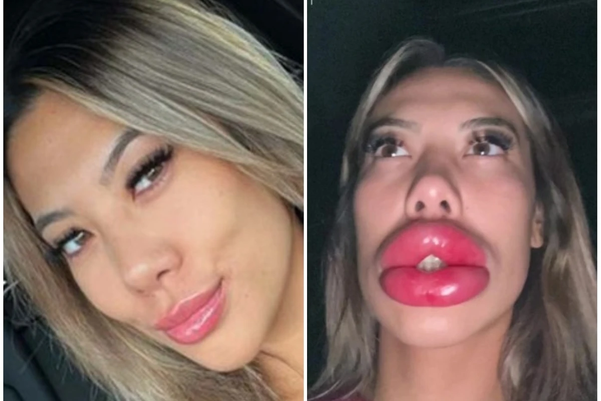 Estetik etdirən qadının dodaqları görənləri ŞOKA SALDI - FOTO