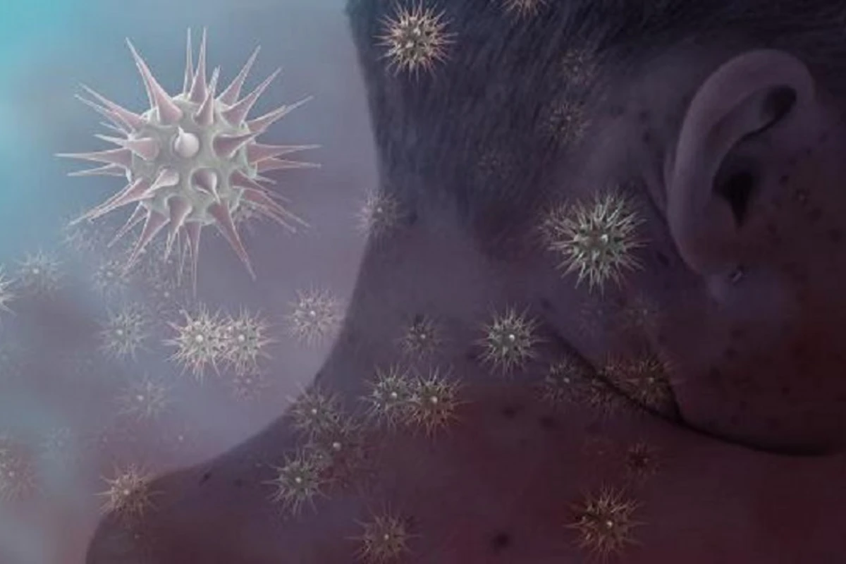 COVID-19-dan sonra yeni virus yayılır - 3 nəfərdən birini öldürür