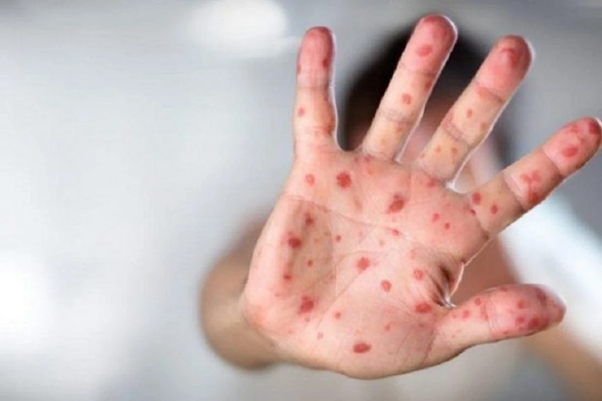 Hansı allergik reaksiyalar zamanı antibiotik təyin edilməlidir? - AÇIQLAMA