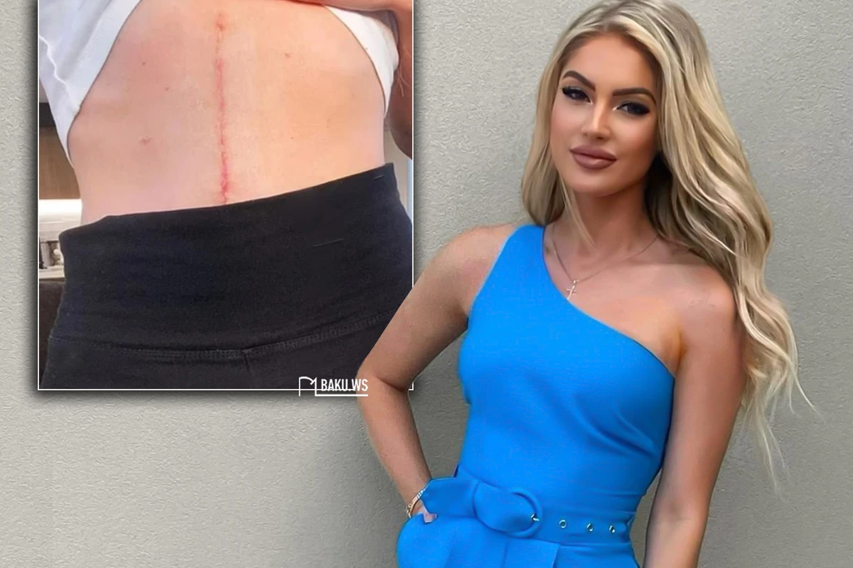 27 yaşlı model xərçəngə tutuldu, 7 saat əməliyyat olundu, sevgilisindən ayrıldı - FOTO