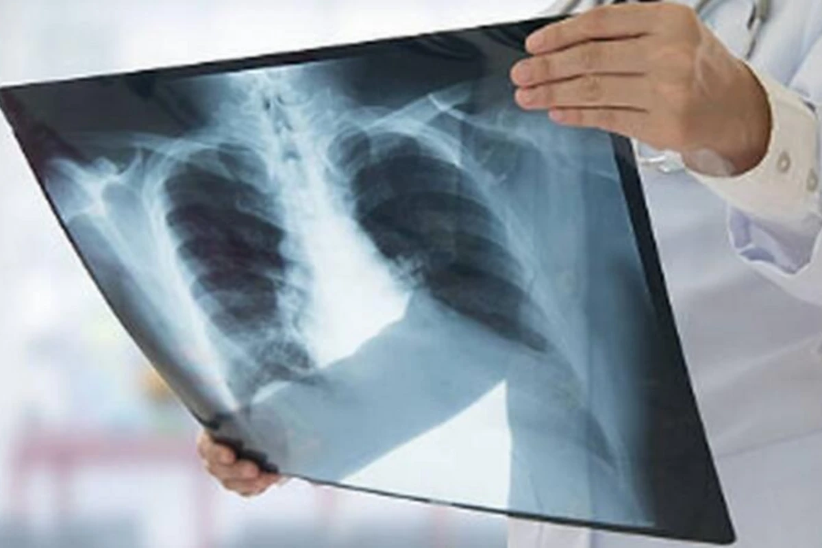 Bunu etsəniz ağ ciyər xərçənginə yoluxma riskiniz 90% azalar