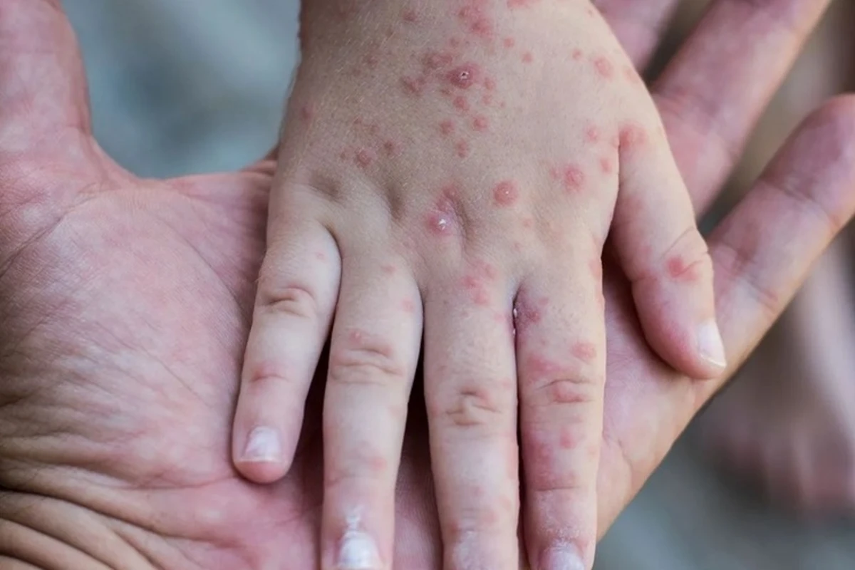 Allergiyalı uşaqlar qızılcaya qarşı peyvənd oluna bilər? - TƏBİB AÇIQLADI