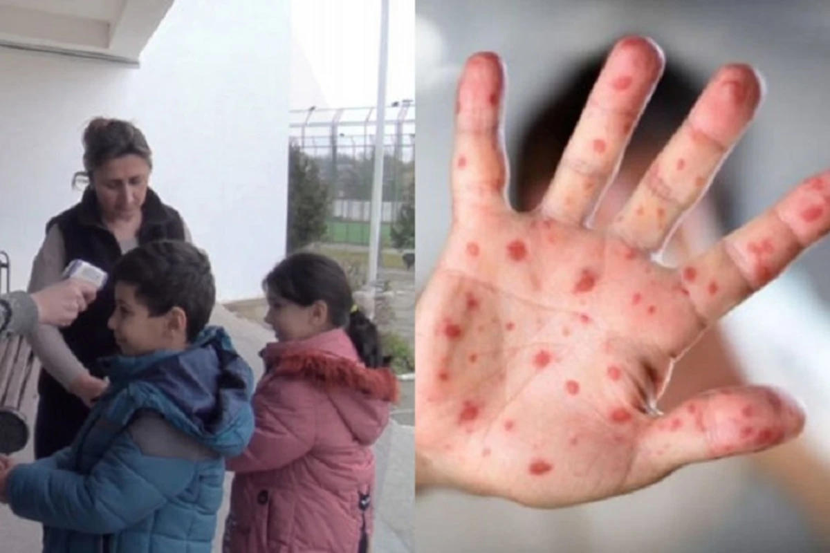 В Гусаре растет число случаев инфицирования корью - ВИДЕО