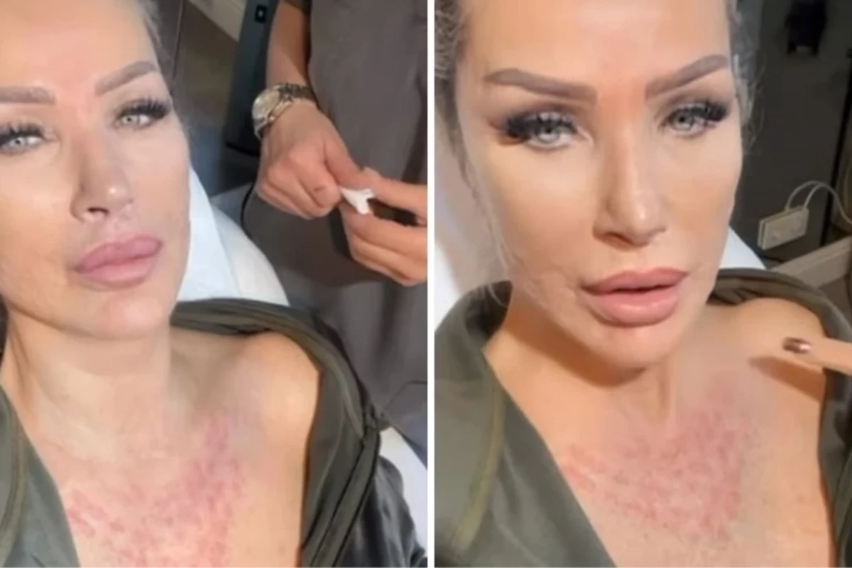 Seda Sayan sünnət dərisindən əldə olunan mayeni üzünə vurdurdu - FOTO