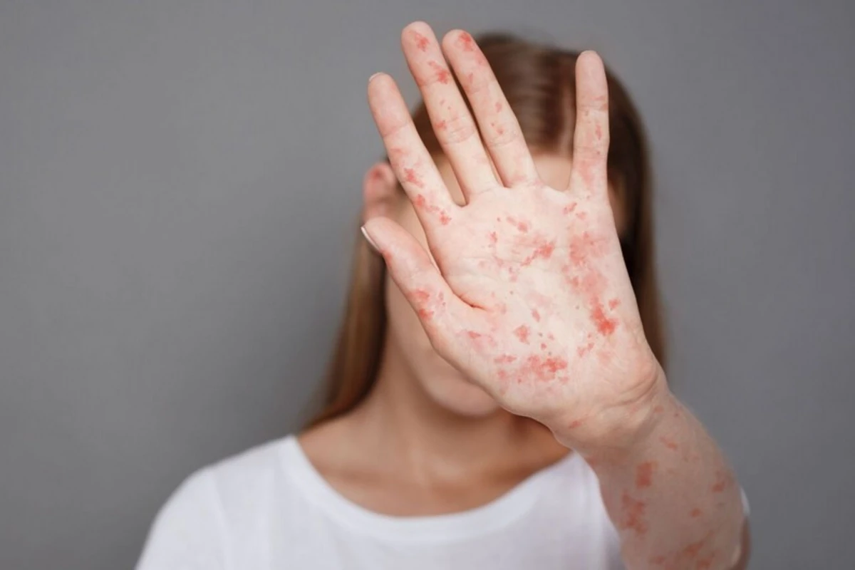 Azərbaycanda qızılcaya yoluxma ilə bağlı son VƏZİYYƏT