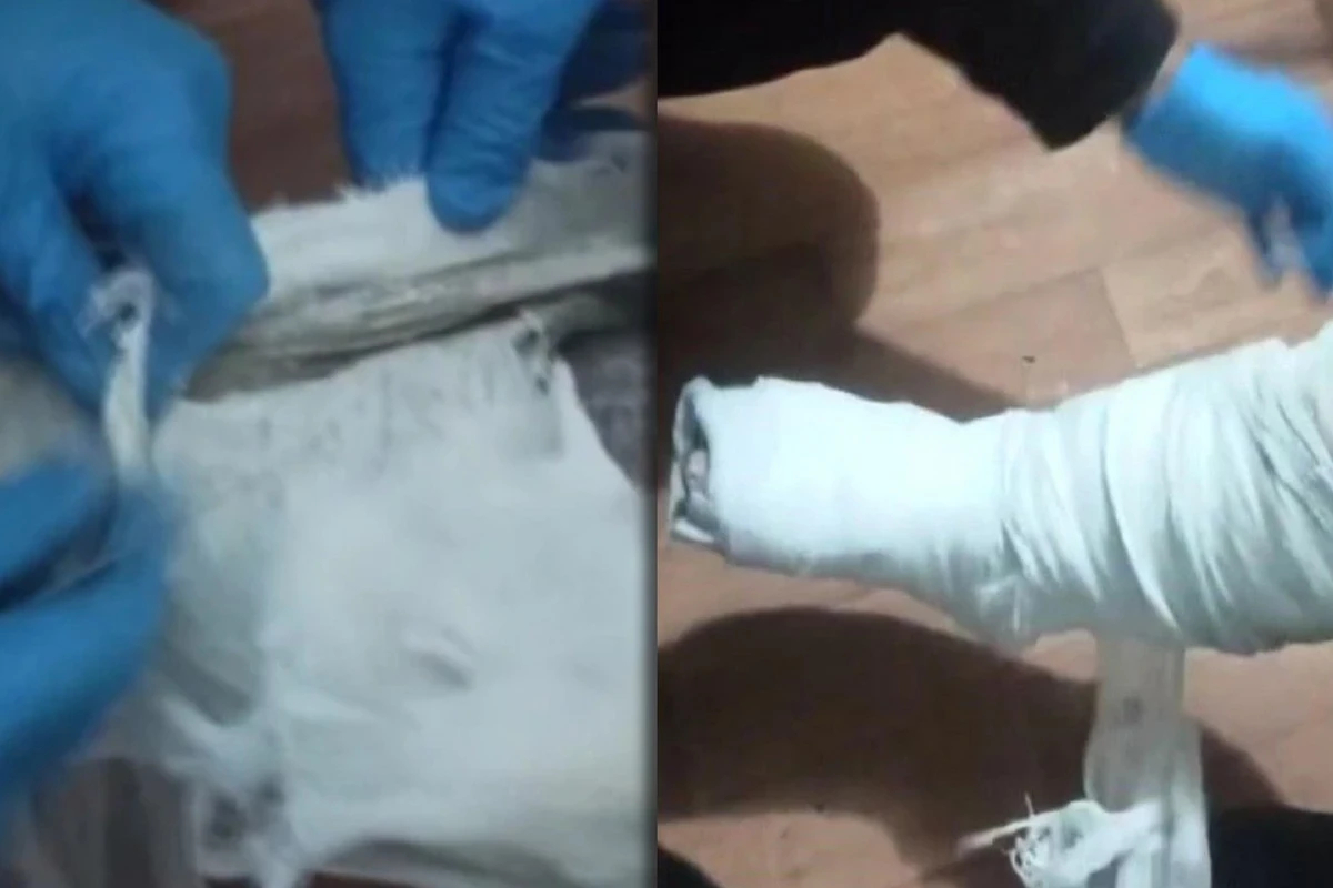 Sərnişinin ayağındakı gipsdən 293 qram heroin çıxdı - FOTO/VİDEO
