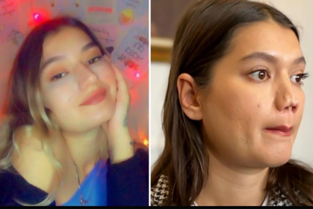 Burnu çürüyən qız həkimdən 1 milyon təzminat tələb edir - FOTO