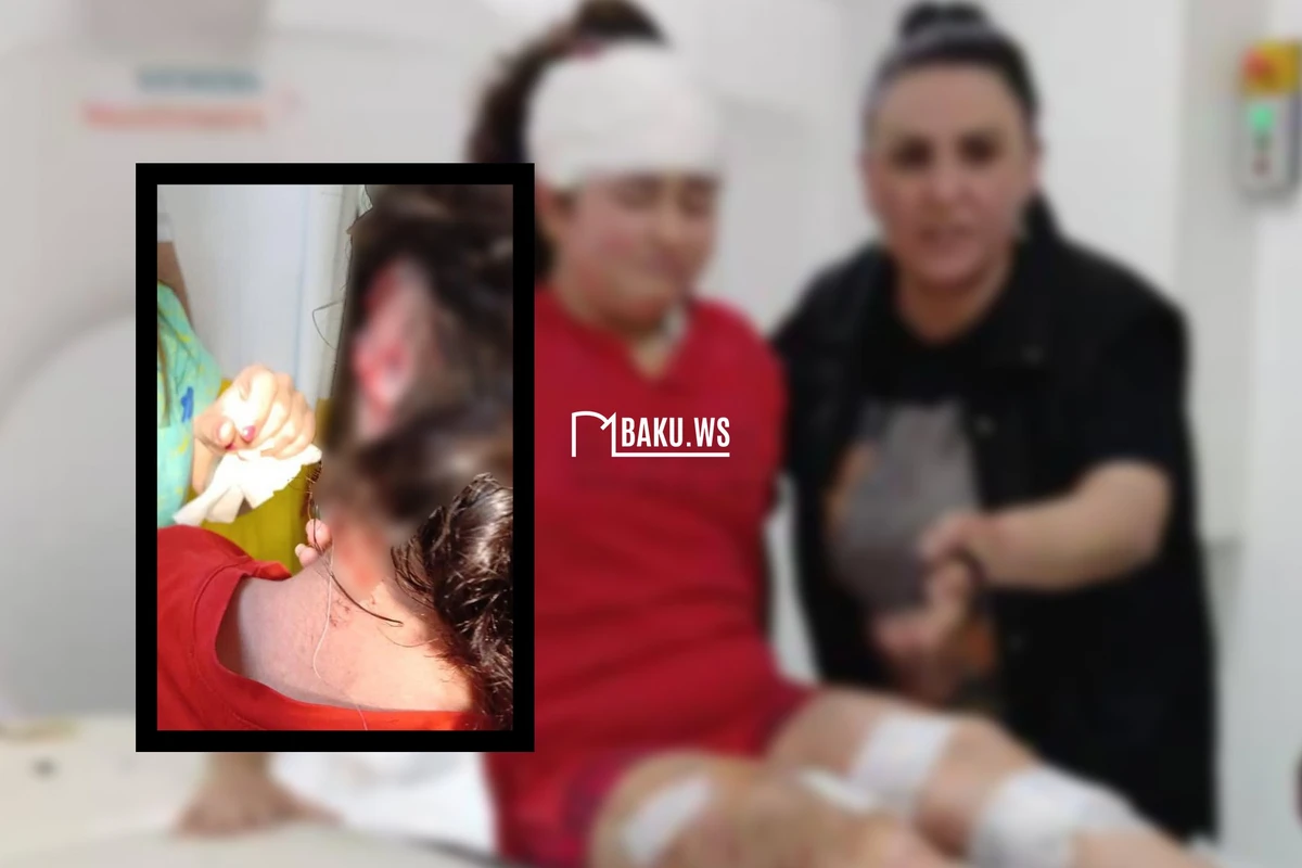 Bakıda it dişləyən azyaşlı qızın SON VƏZİYYƏTİ AÇIQLANIB - FOTO