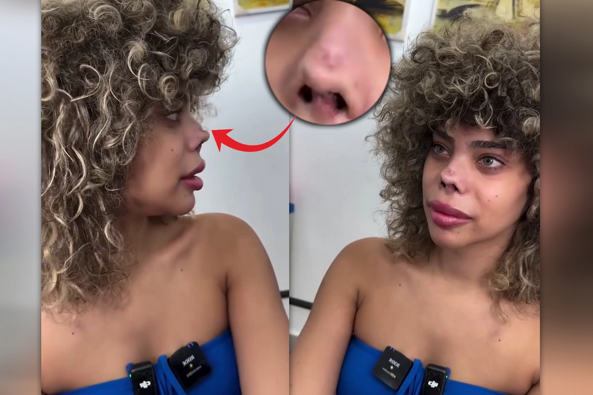 В Турции женщина лишилась половины носа после пластической операции