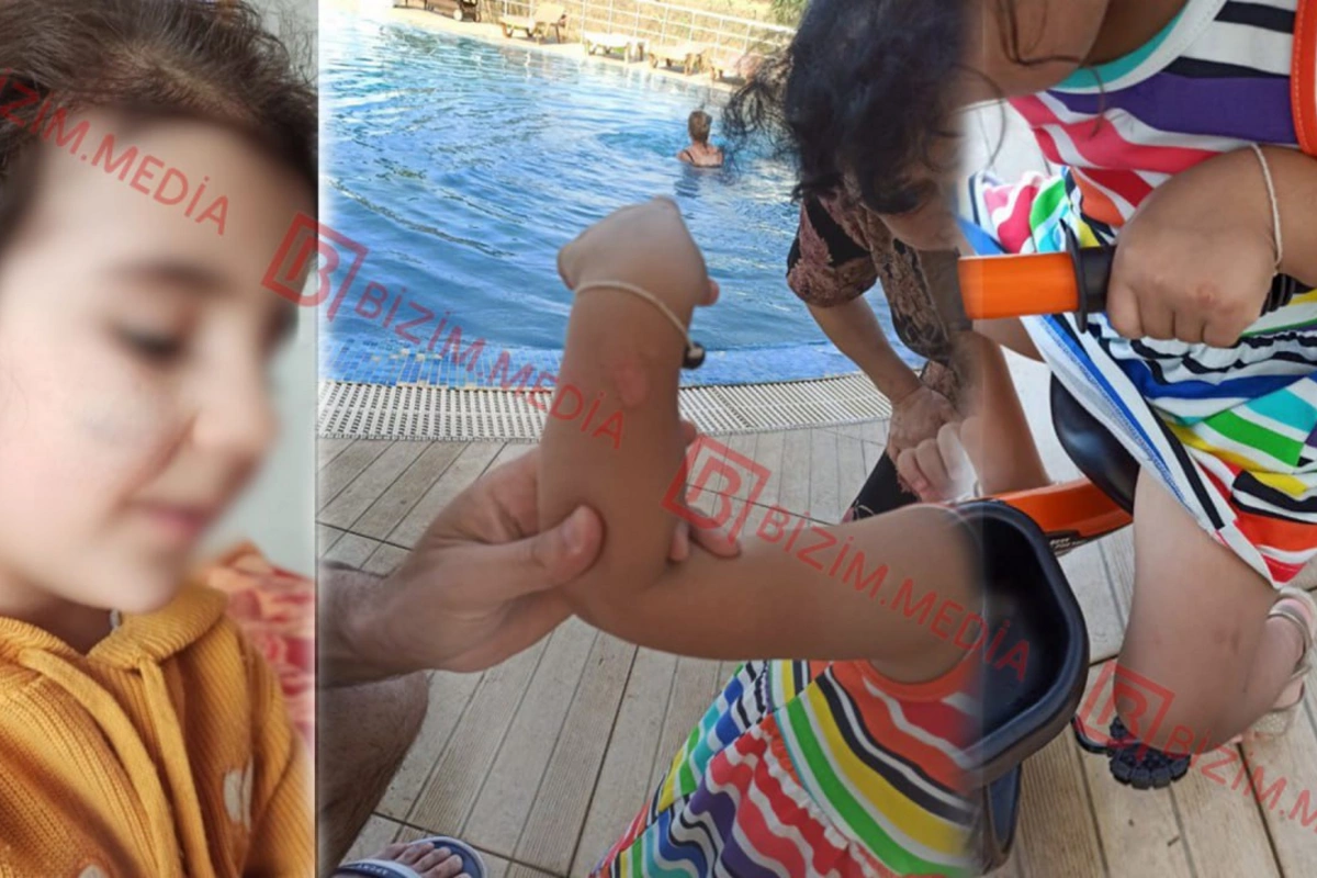 Lənkəranda qandonduran HADİSƏ – Ana isti qaşıqla 3 yaşlı qızının qolunu DAĞLADI