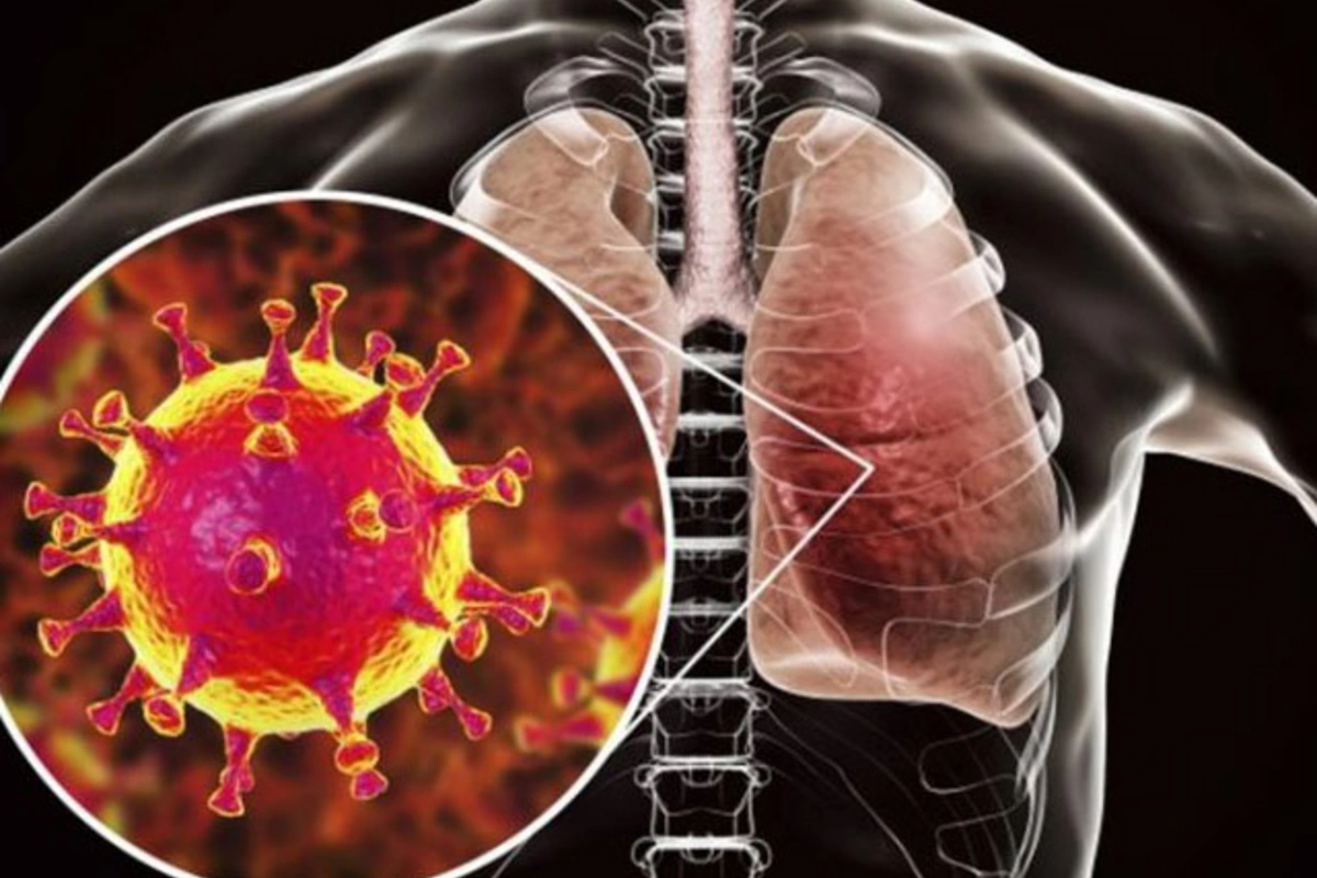 Pnevmoniya sürətlə yayılır? - İnsanların gec sağalma SƏBƏBLƏRİ