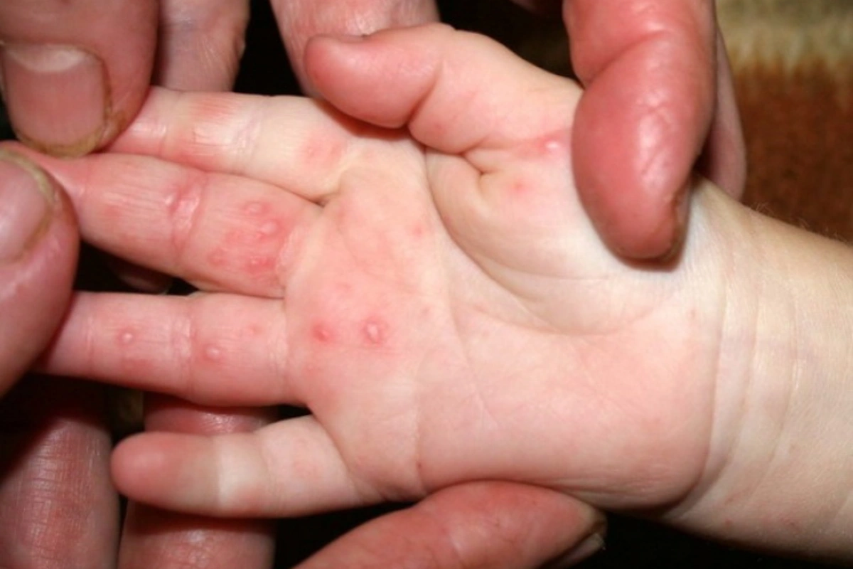 Ölümcül virus qonşu ölkənin məktəb və bağçalarına çatdı Ölümcül virus qonşu ölkənin məktəb və bağçalarına çatdı
