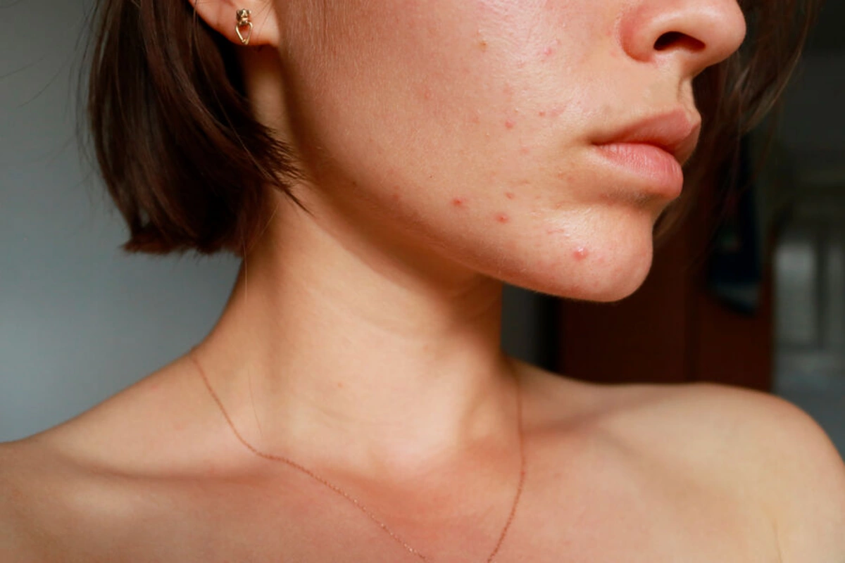 Student in Vietnam died after popping pimples