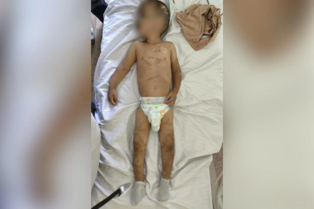 Ağdamda işgəncəyə məruz qalan körpələrin son durumu: Biri Neyrocərrahiyyə Xəstəxanasına aparılıb Ağdamda işgəncəyə məruz qalan körpələrin son durumu: Biri Neyrocərrahiyyə Xəstəxanasına aparılıb