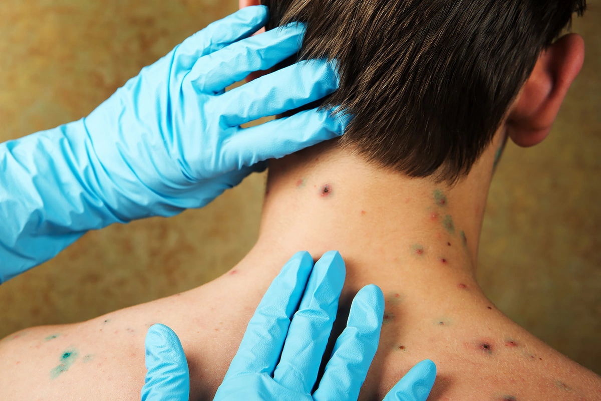 Врач рассказала, можно ли заболеть ветрянкой во второй раз Врач рассказала, можно ли заболеть ветрянкой во второй раз