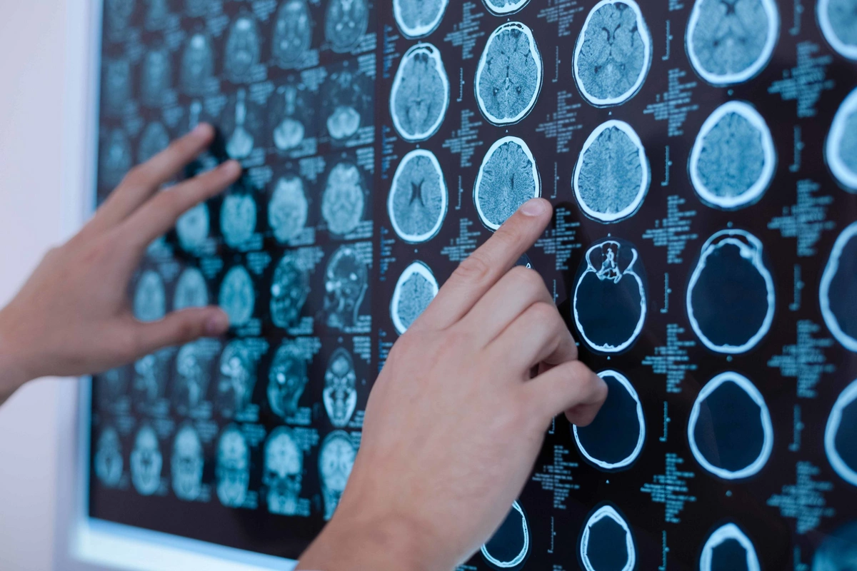 Simple habit helped reduce stroke risk Simple habit helped reduce stroke risk