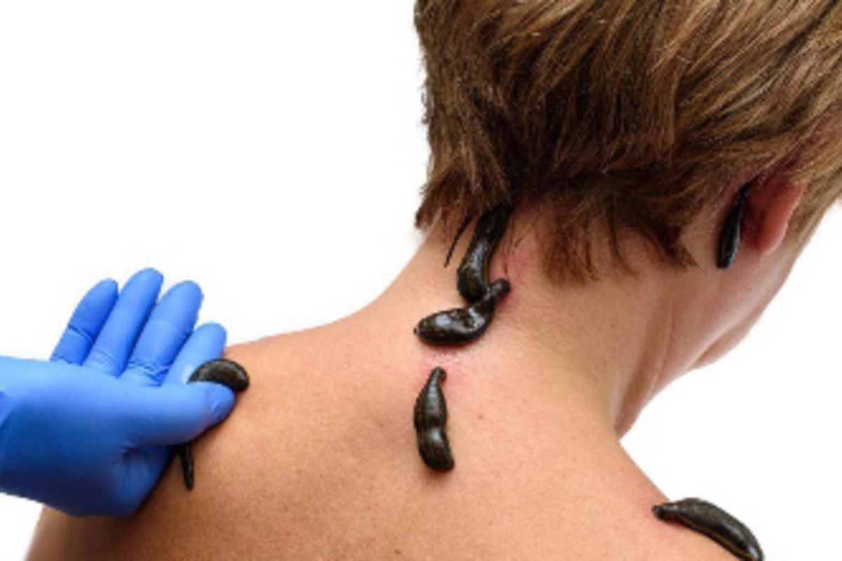 Leech therapy: why the procedure has no place in the 21st century? Leech therapy: why the procedure has no place in the 21st century?