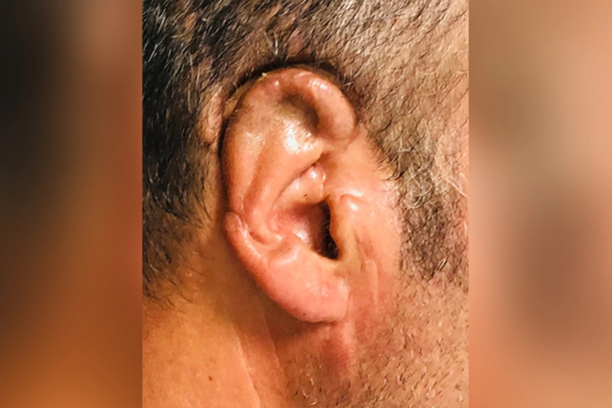 Bakıda kişinin qopan qulağı 34 saat sonra yerinə tikildi