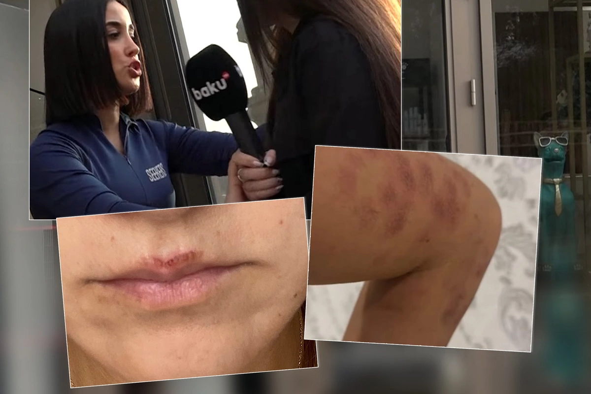 Bakıda salonda qadını lazer edərkən yandırdılar - İDDİA Bakıda salonda qadını lazer edərkən yandırdılar - İDDİA