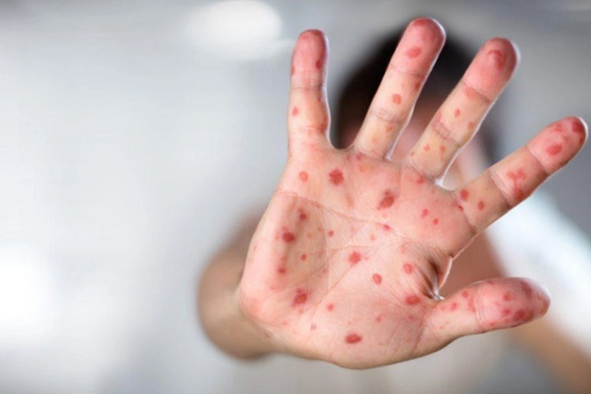 Hazırda Azərbaycanda qızılca və suçiçəyi ilə bağlı epidemioloji vəziyyət sabitdir - RƏSMİ