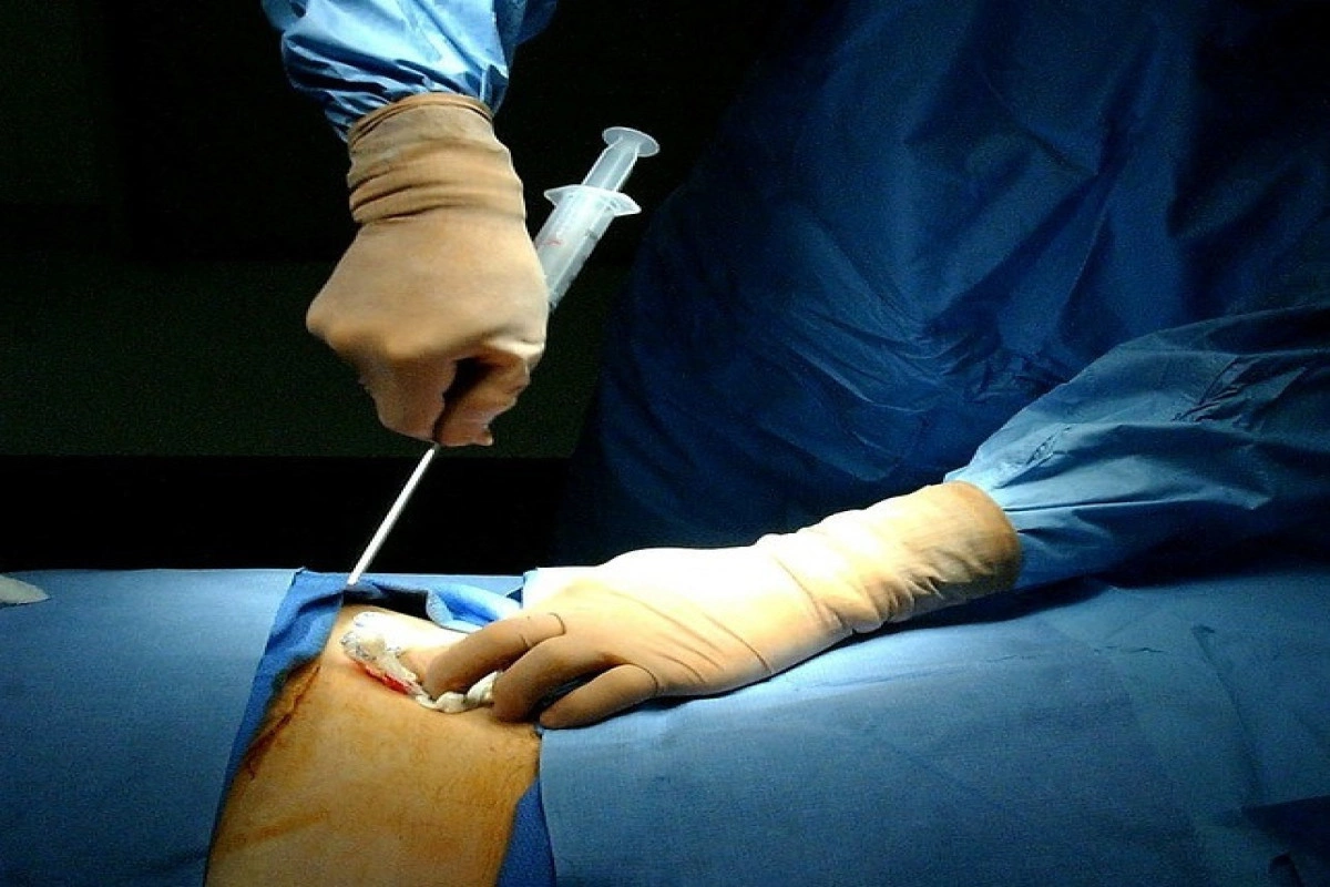 Sümük iliyinin transplantasiyasının limiti artırılıb