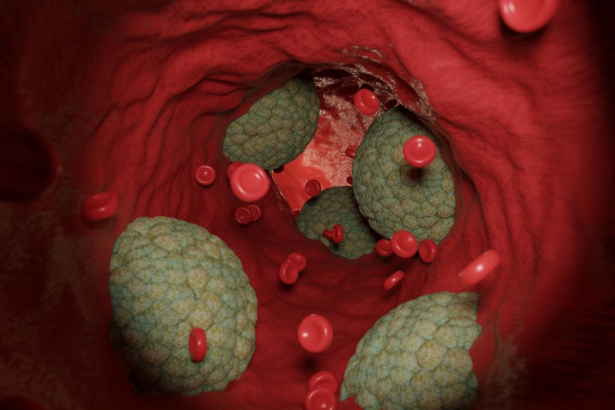 Vaxtından əvvəl ölümlə nəticələnə biləcək gözlənilməz risk faktoru aşkarl