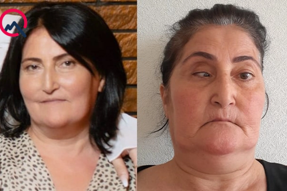 54 yaşlı qadının burnun düzəldəndə gözünü zədələdilər
