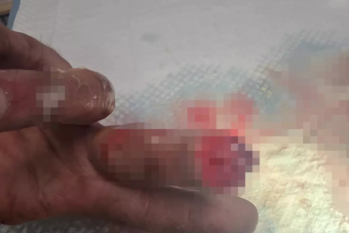 Barmağı qopan şəxs onu buzda saxlayaraq Türkiyəyə çatdırdı