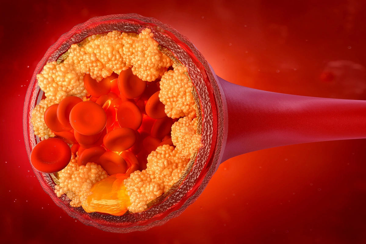 A simple way to reduce the level of bad cholesterol in the blood has been named