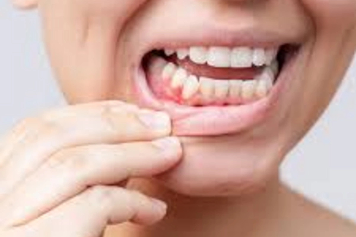 An unexpected link named between gum health and heart diseases