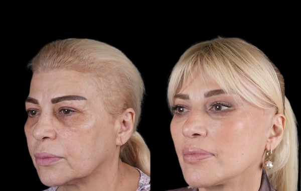 Mətanət İsgəndərli əməliyyatdan ƏVVƏL VƏ SONRA